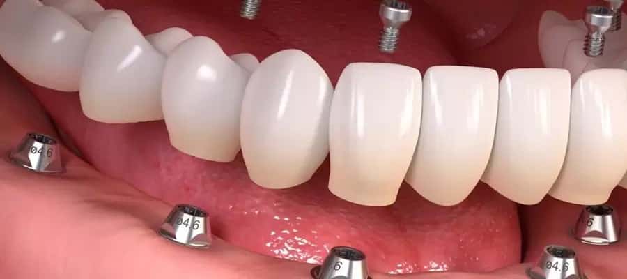 Dental Implant