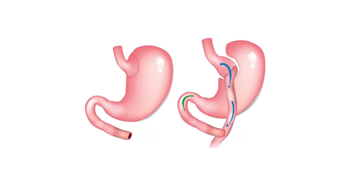 Top 5 Gastric Bypass Clinics in USA