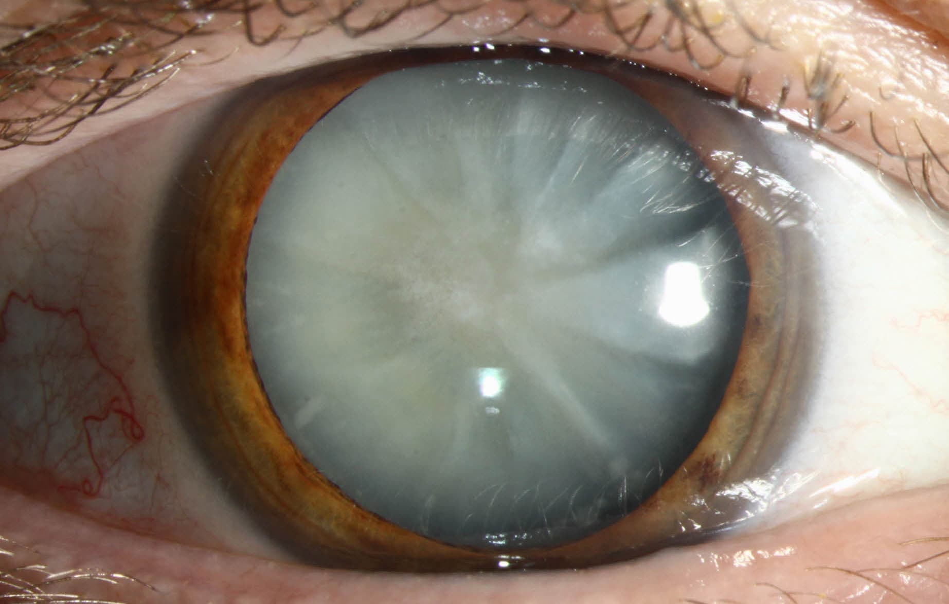 Top 10 Cataract Surgery Clinics in USA