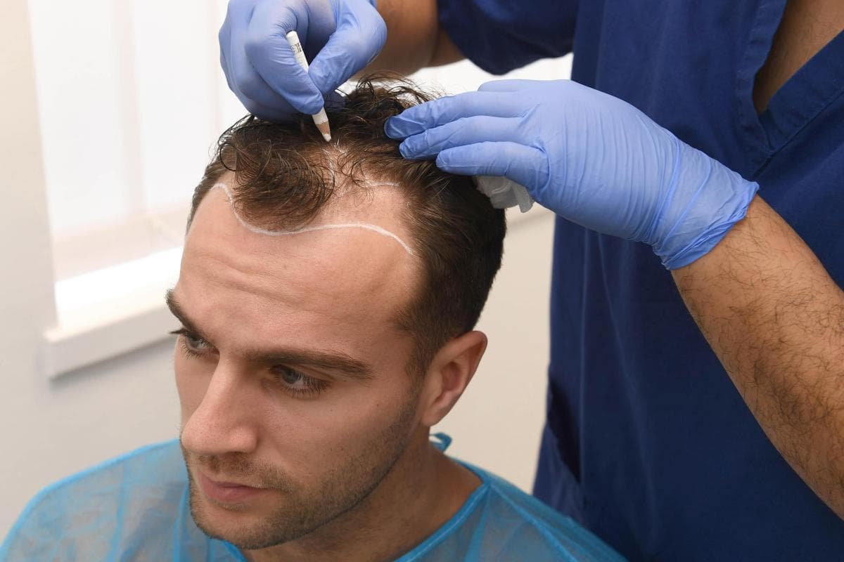 Top 10 Hair Transplant Clinics in Brazil