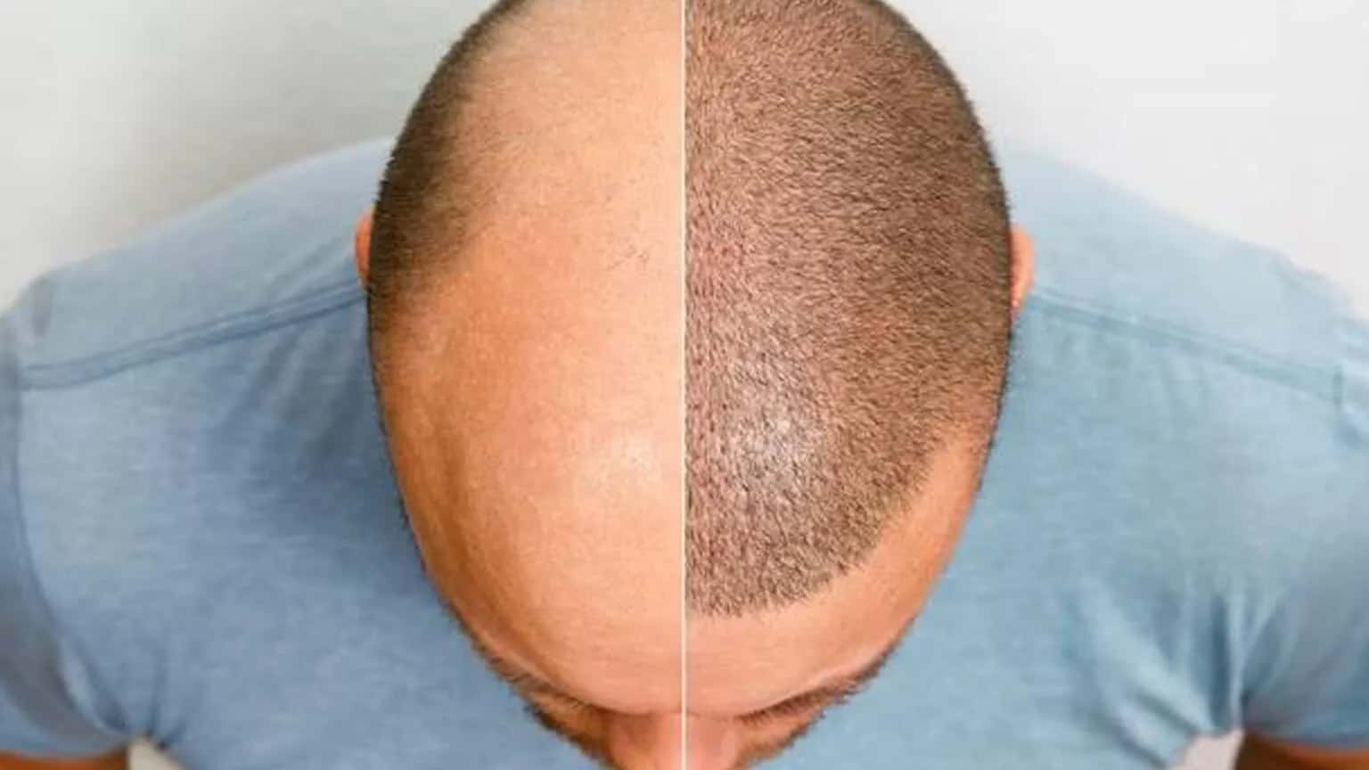 2 Meses Após Transplante Capilar: Como Fica o Cabelo Nessa Fase?
