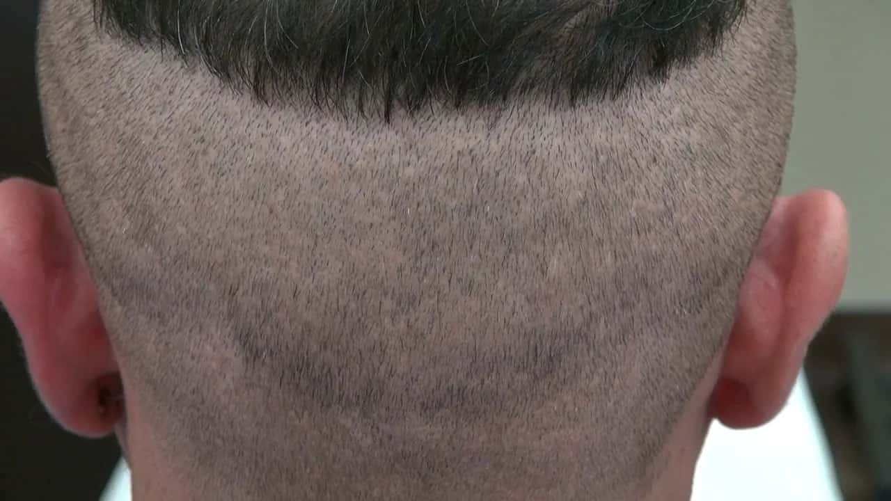 20 Dias Após Transplante Capilar