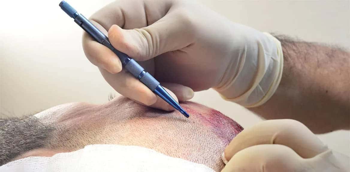 7 Dias Após Transplante Capilar FUE