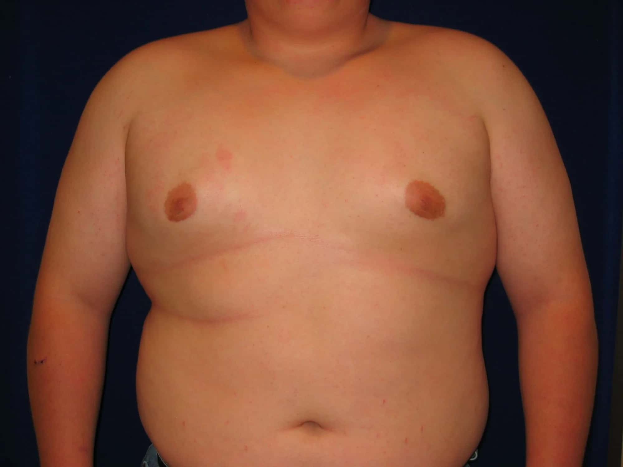 Adipomastia: Causes, Symptoms, Diagnosis and Treatment