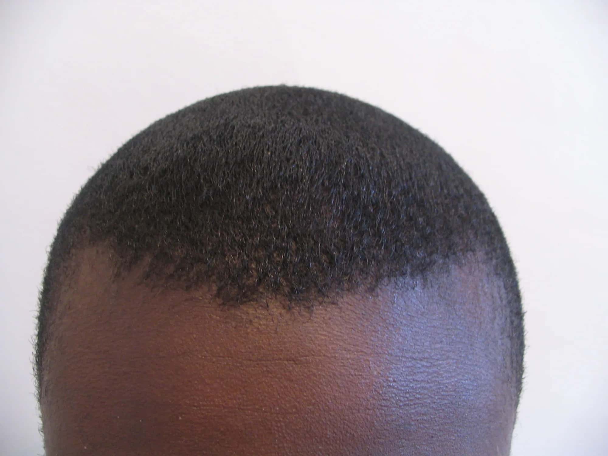 Afro Hair Transplant Costs Around the World