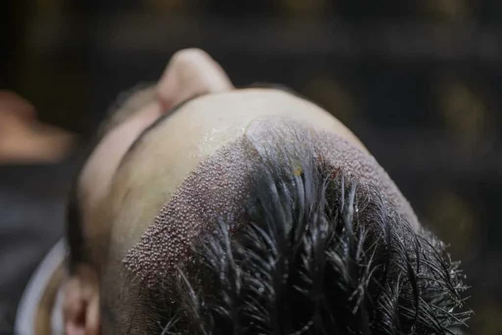 Área Doadora Transplante Capilar