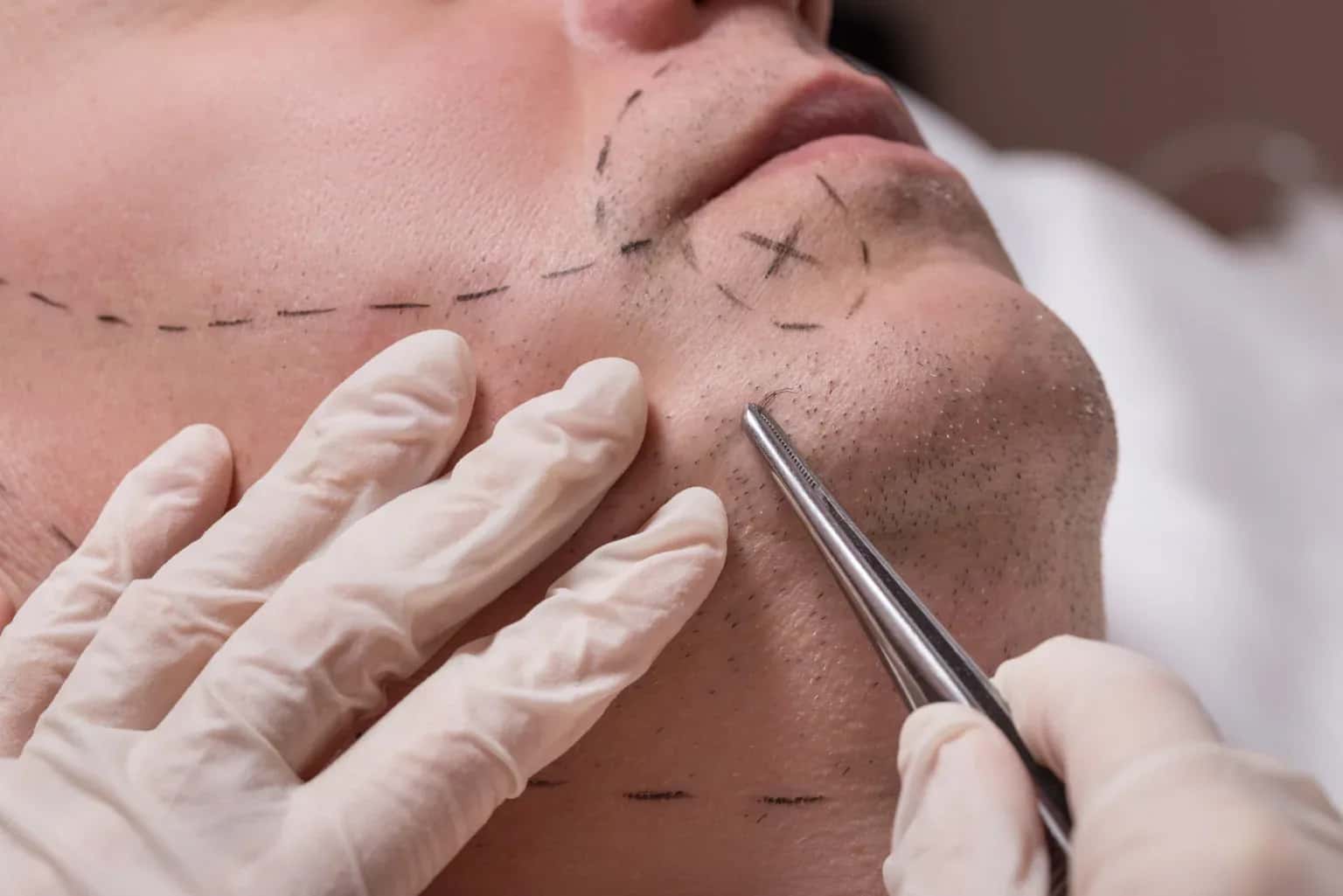 Beard Transplant Costs Around the World: 2026 Country-by-Country Guide