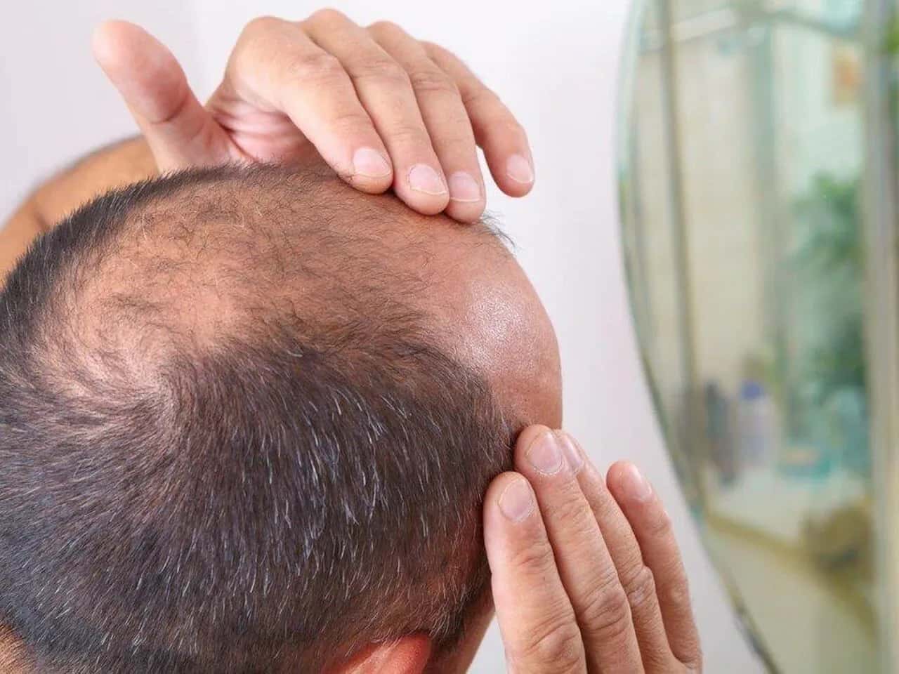 Bilim İnsanları Kelliğe Çare mi Buldu? Saç Yeniden Çıkarmada Son Dönüm Noktaları