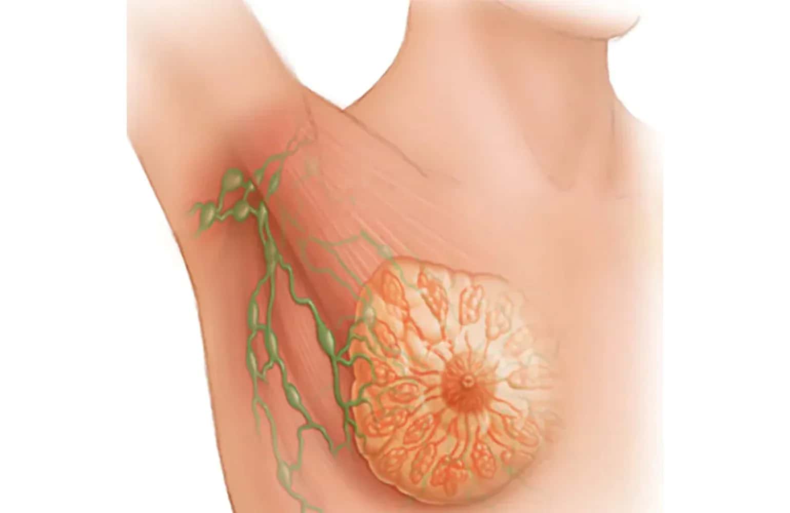 Breast Cancer: Overview