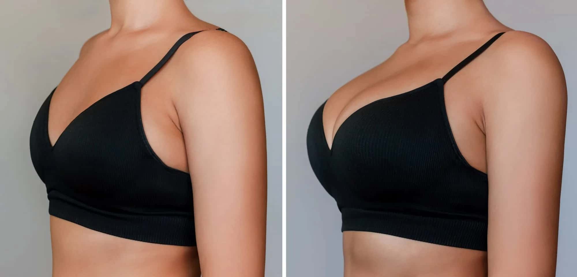 Breast Implant Removal Without Replacement