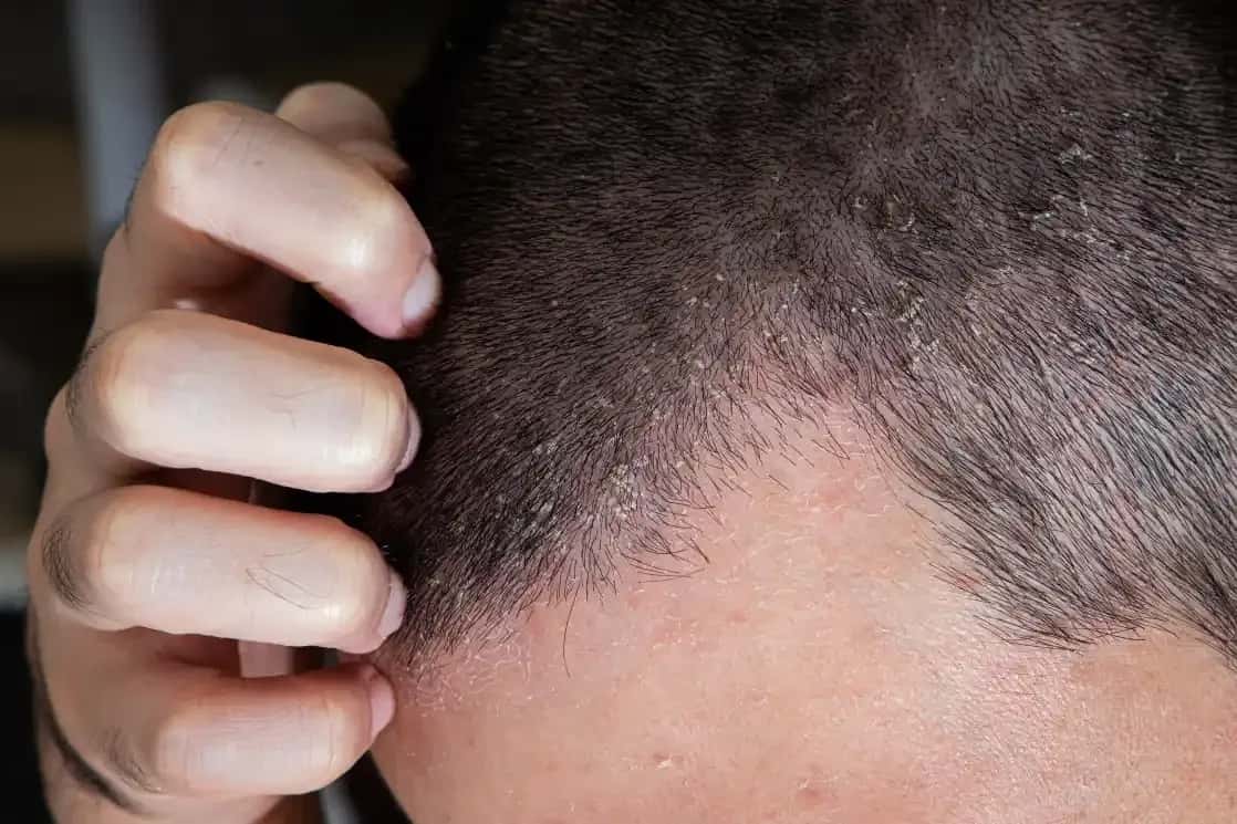 Can You Get a Hair Transplant With Seborrheic Dermatitis?