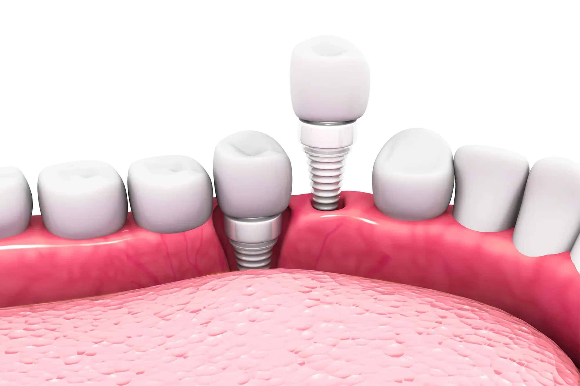 Ceramic Dental Implants: Benefits, Risks and Long-Term Results