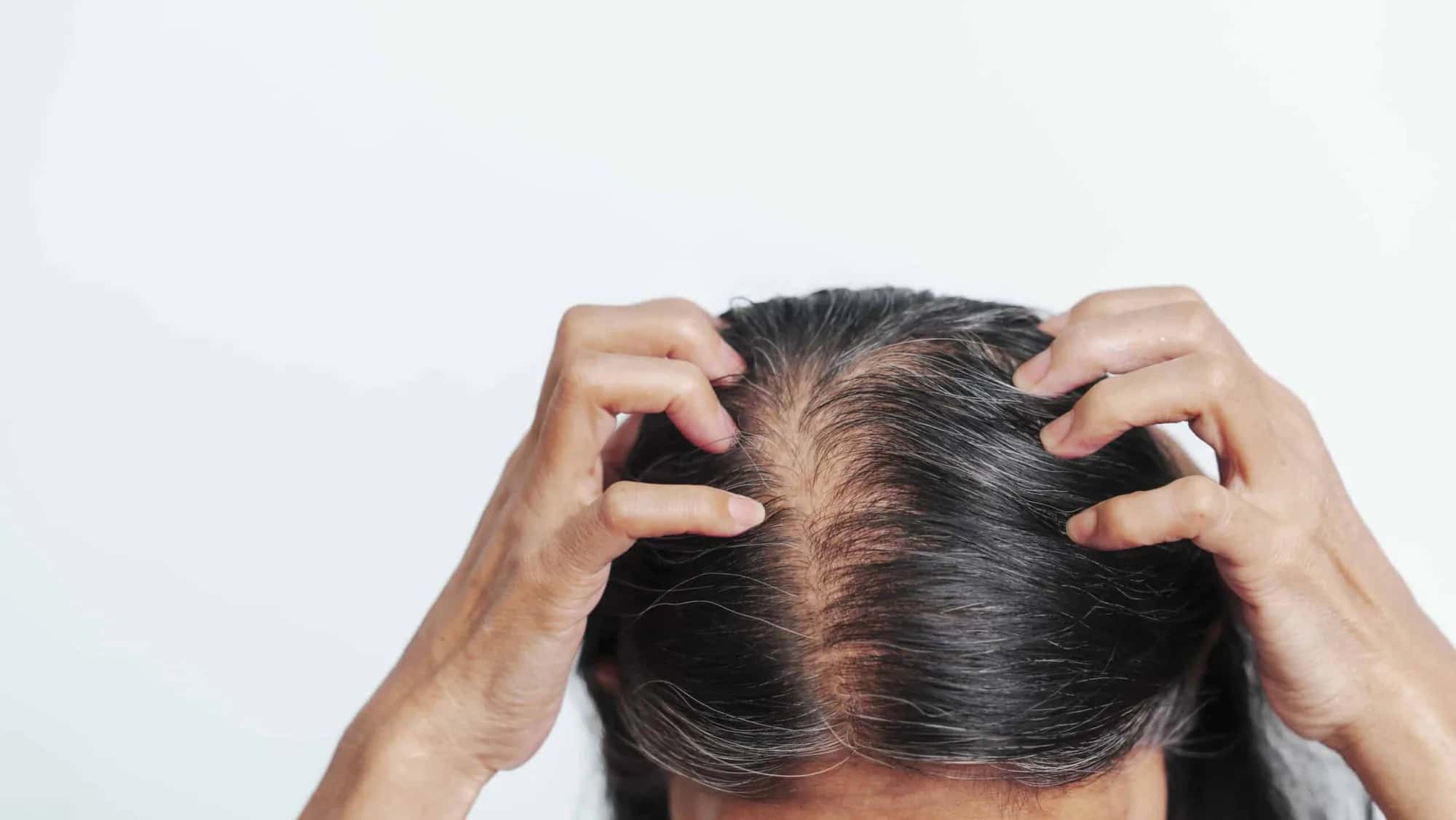 Chute de cheveux sous buspirone (Buspar)