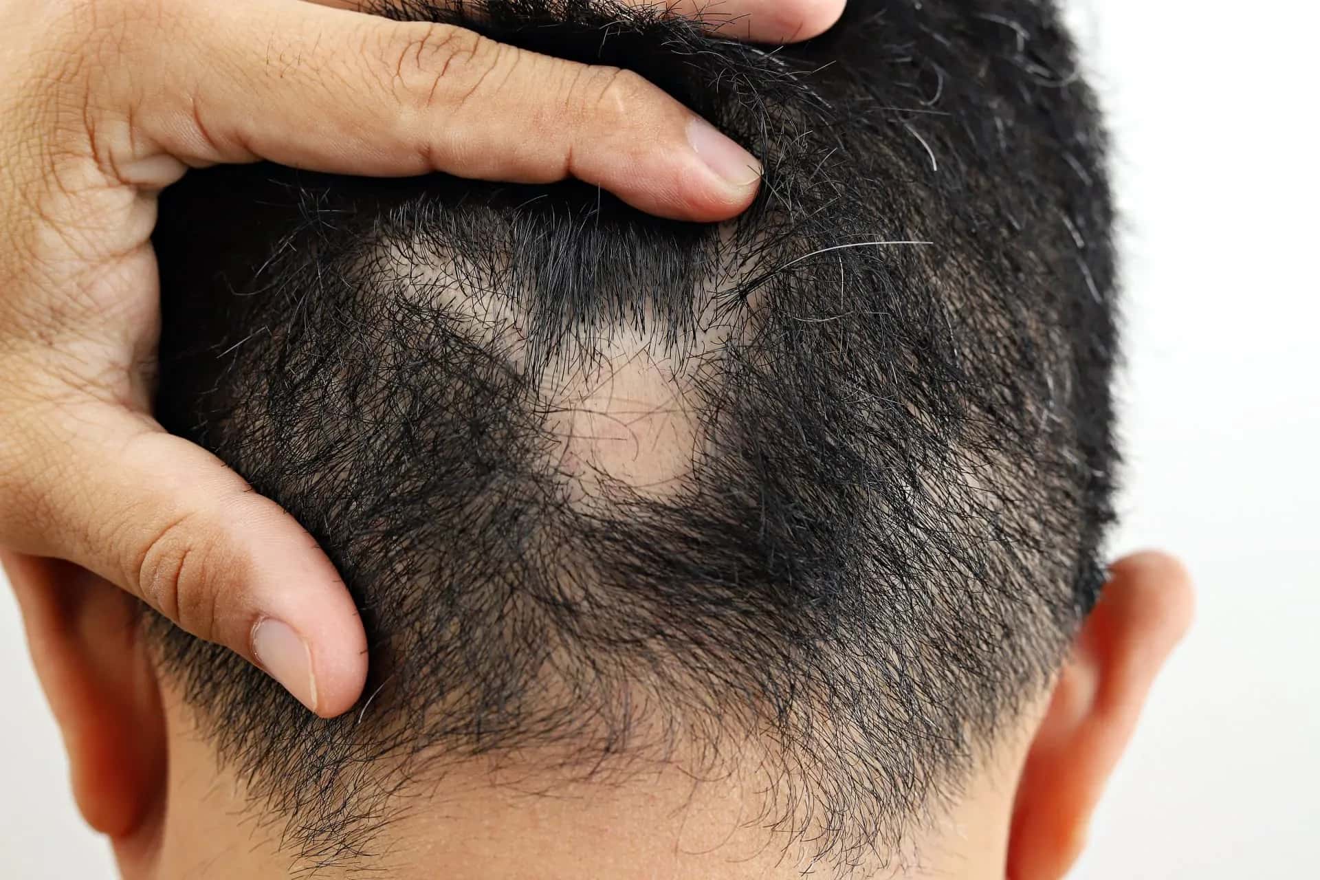 Cicatricial Alopecia: Symptoms, Causes, Diagnosis and Treatment