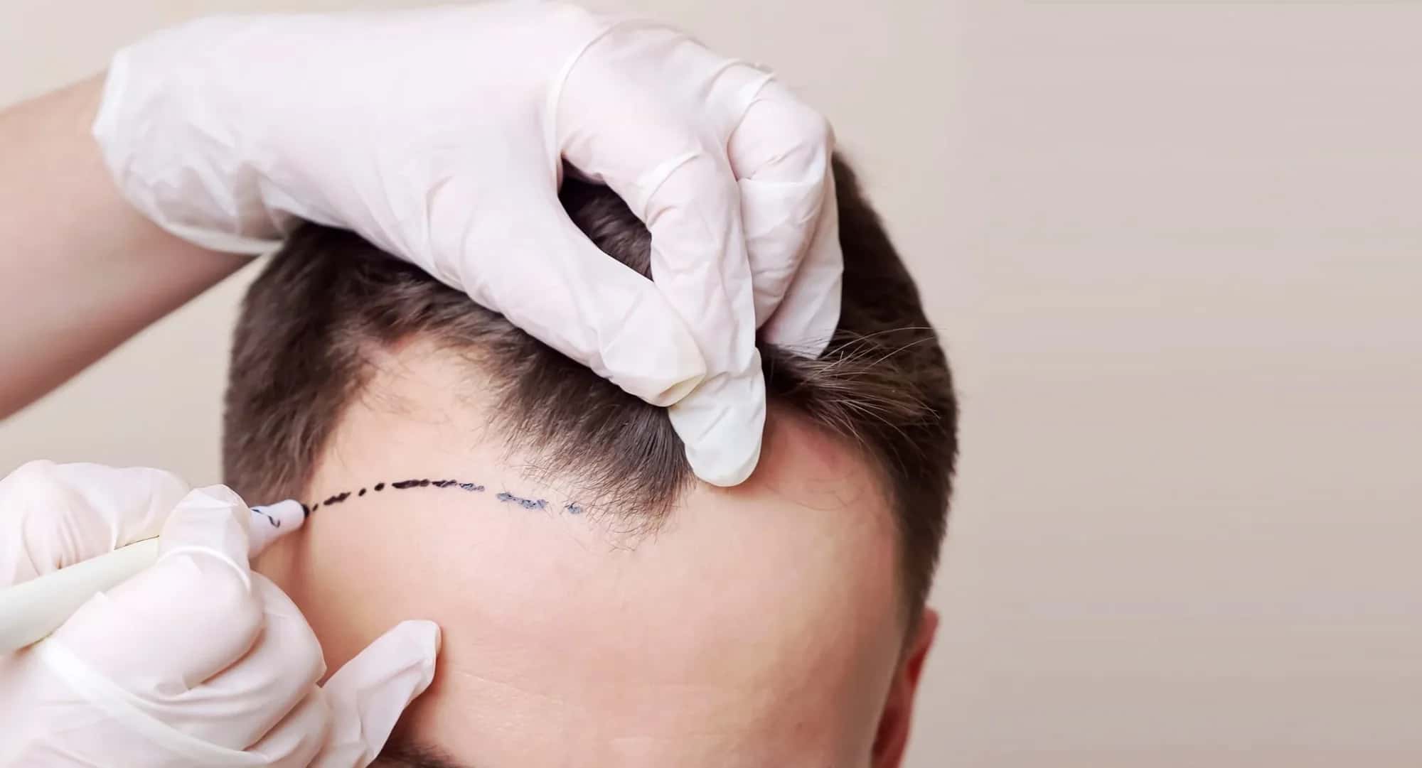 Comparing FUE and FUT Hair Transplants