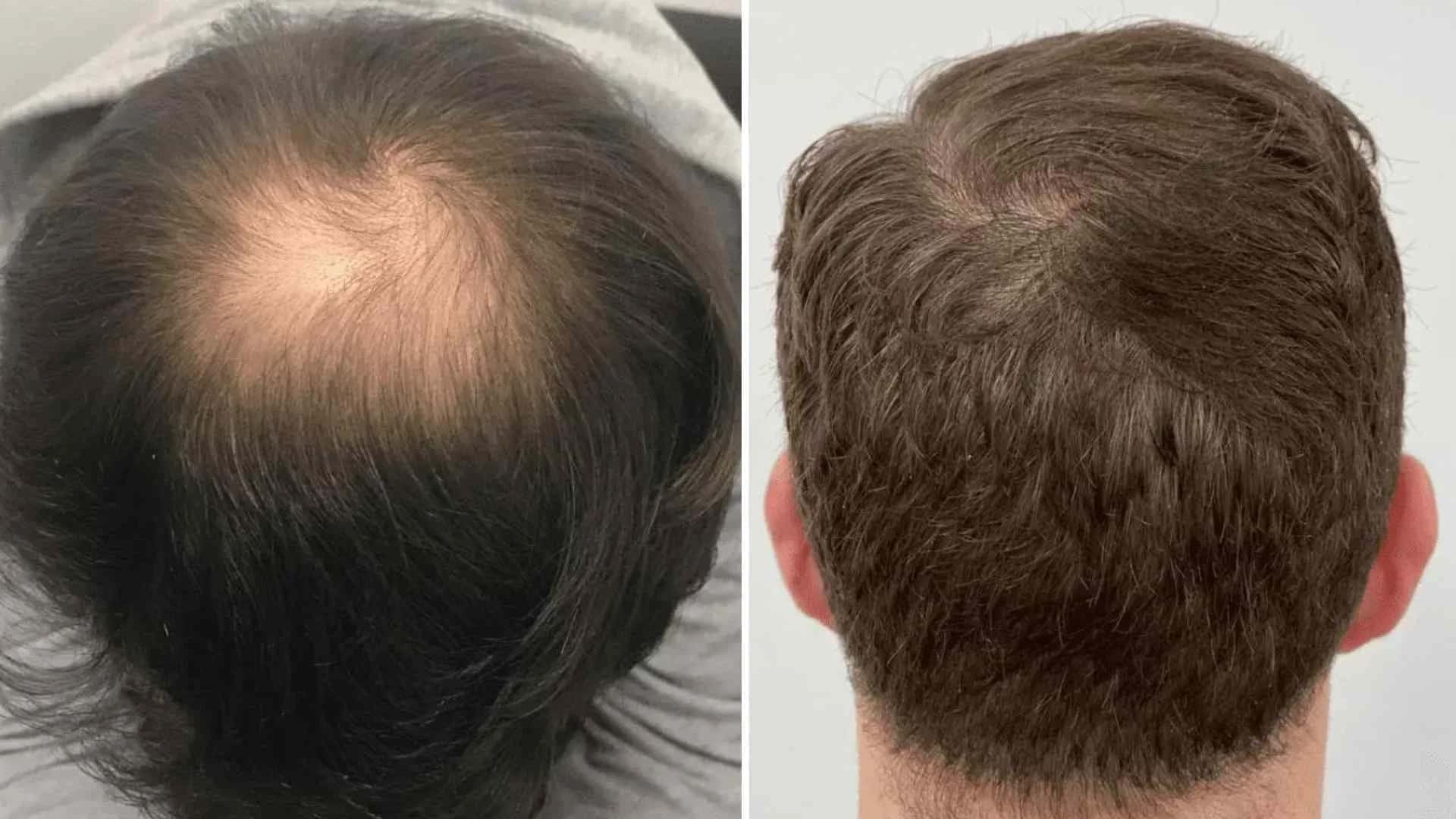 Crown Hair Transplant Costs Around the World: 2026 Country-by-Country Guide