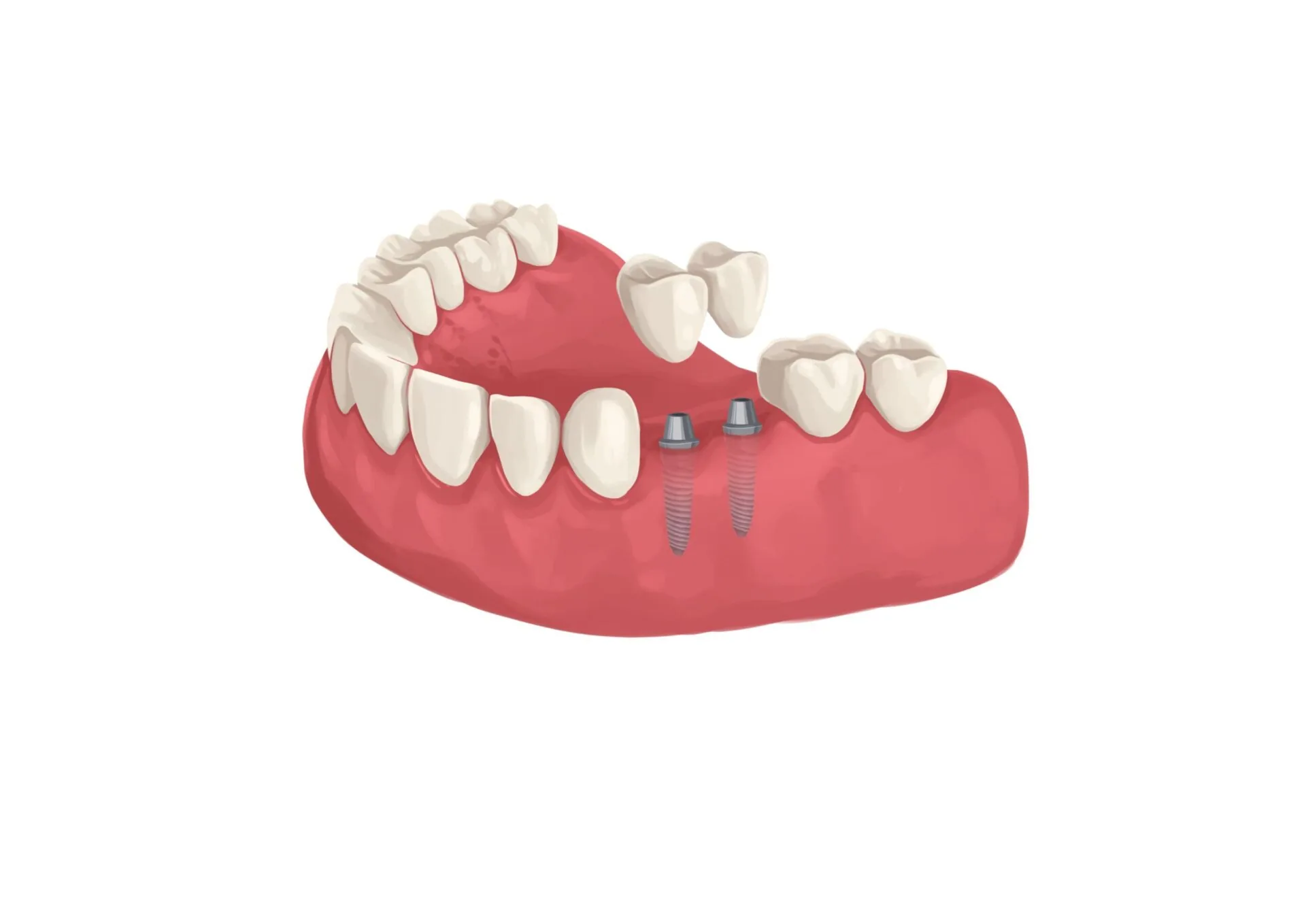 Dental Implant Recovery Timeline