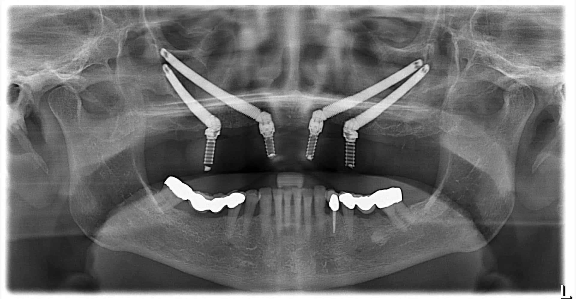 Dental Implants With Bone Loss