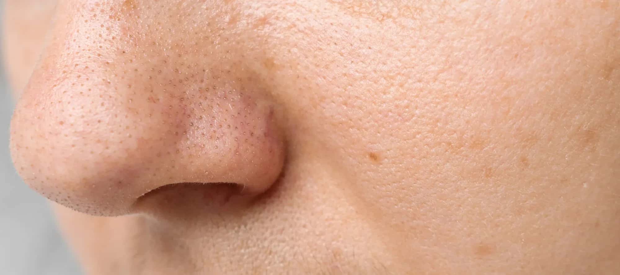 DIY Remedies for Tightening Enlarged Pores