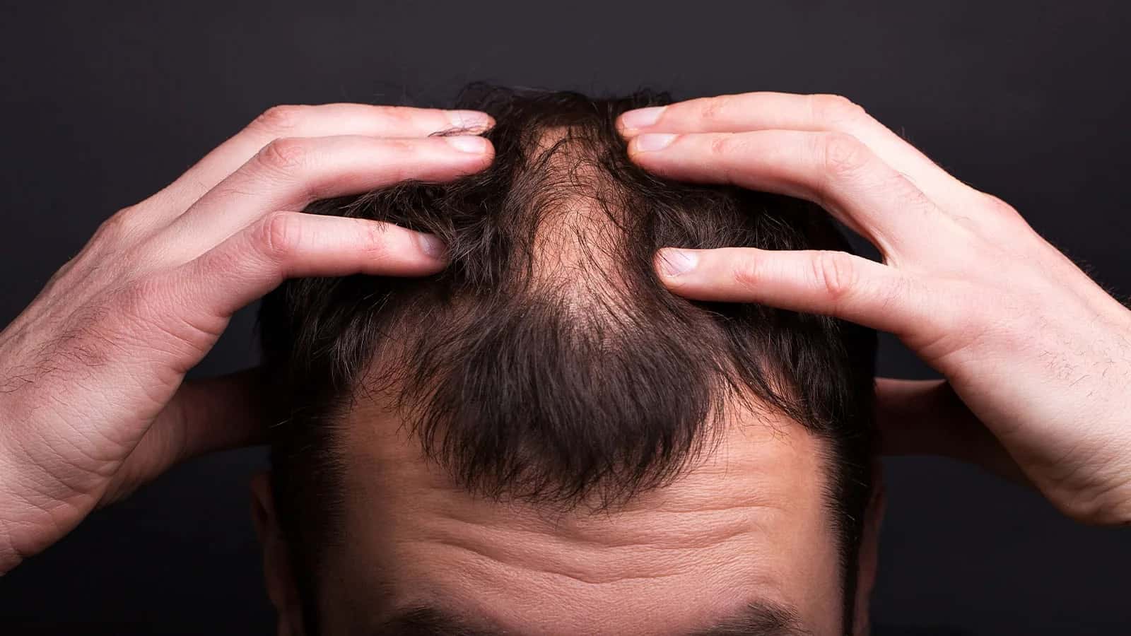 Does Hair Lost Due to Hormonal Factors Grow Back?