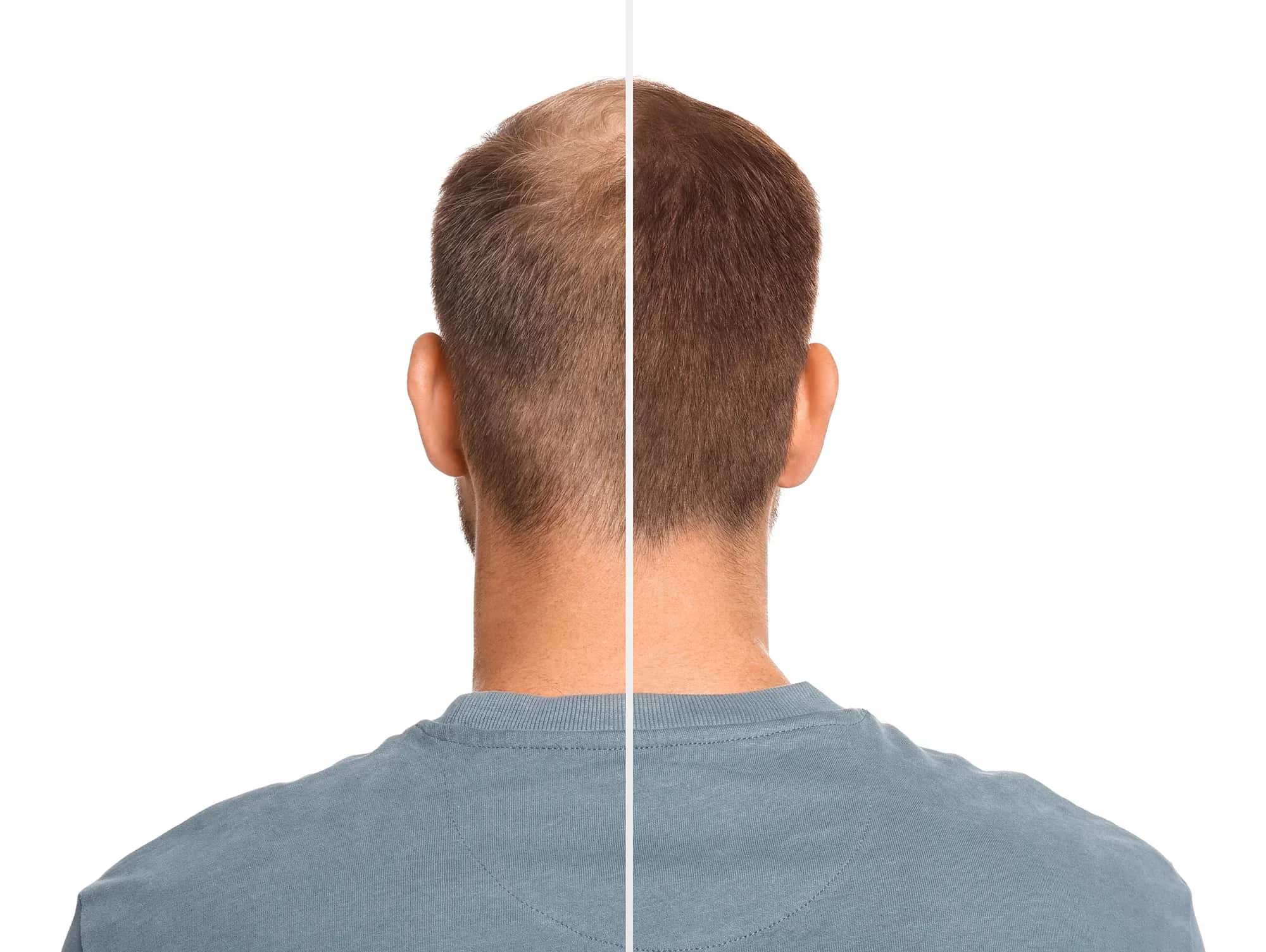 Erfolgsrate einer Haartransplantation am Vertex
