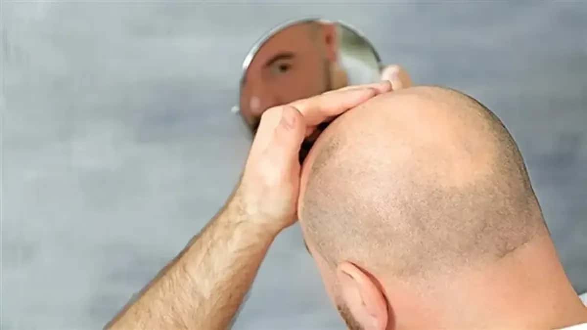 Famosos Que Fizeram Transplante Capilar