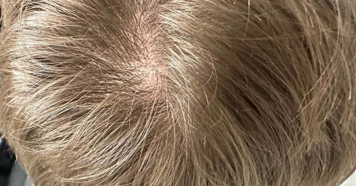 Folliculite après une greffe de cheveux