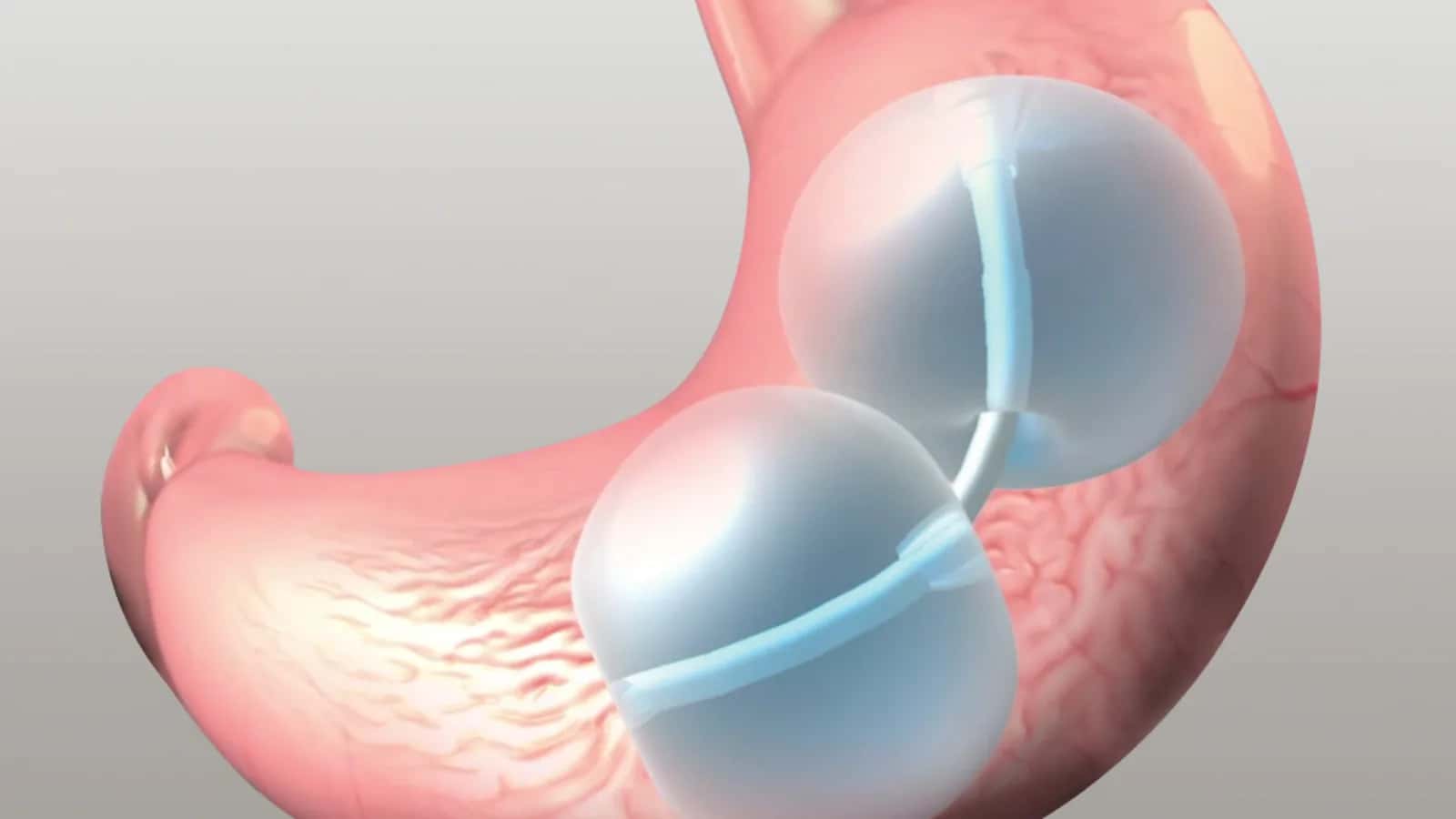 Gastric Balloon vs GLP-1 Injections