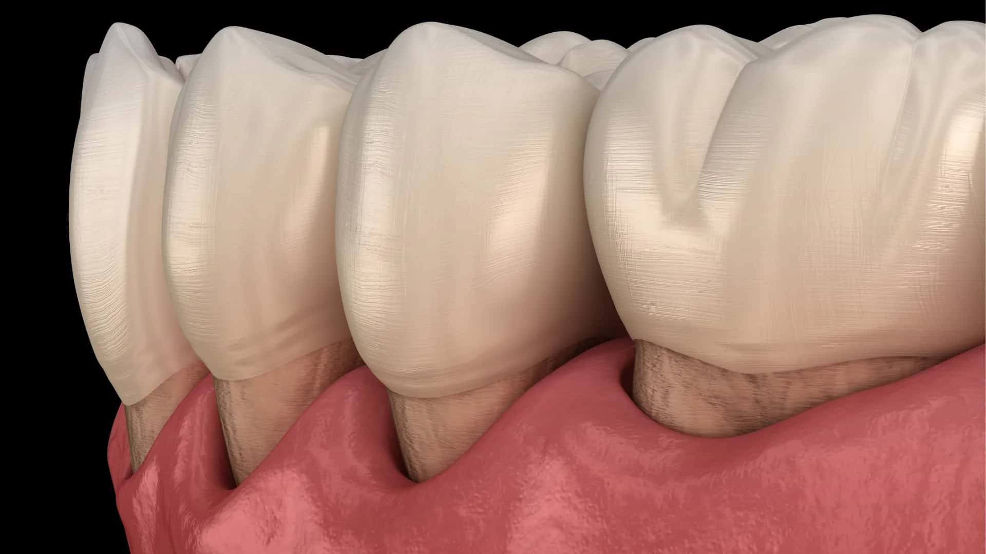 Gum Recession Around Dental Implants