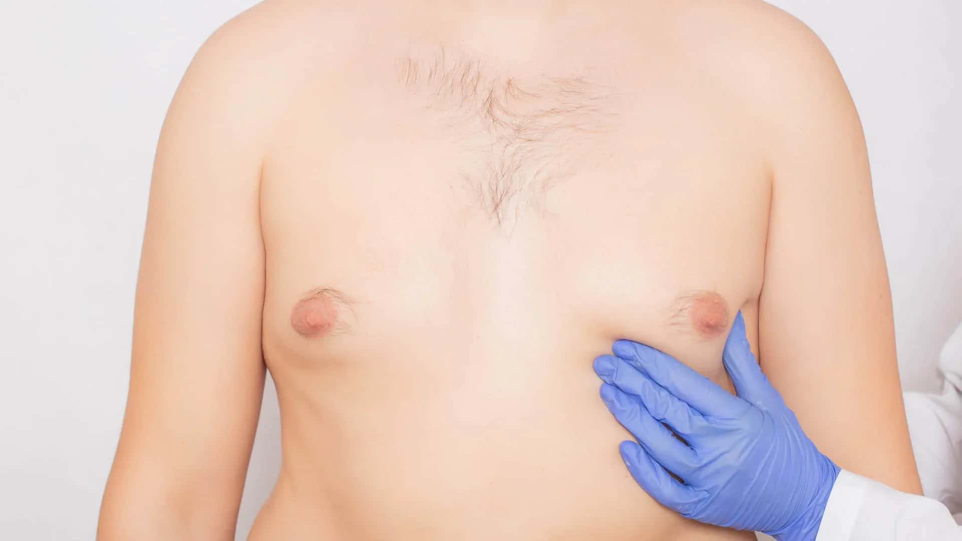 Gynecomastia vs. Chest Fat: How to Tell the Difference