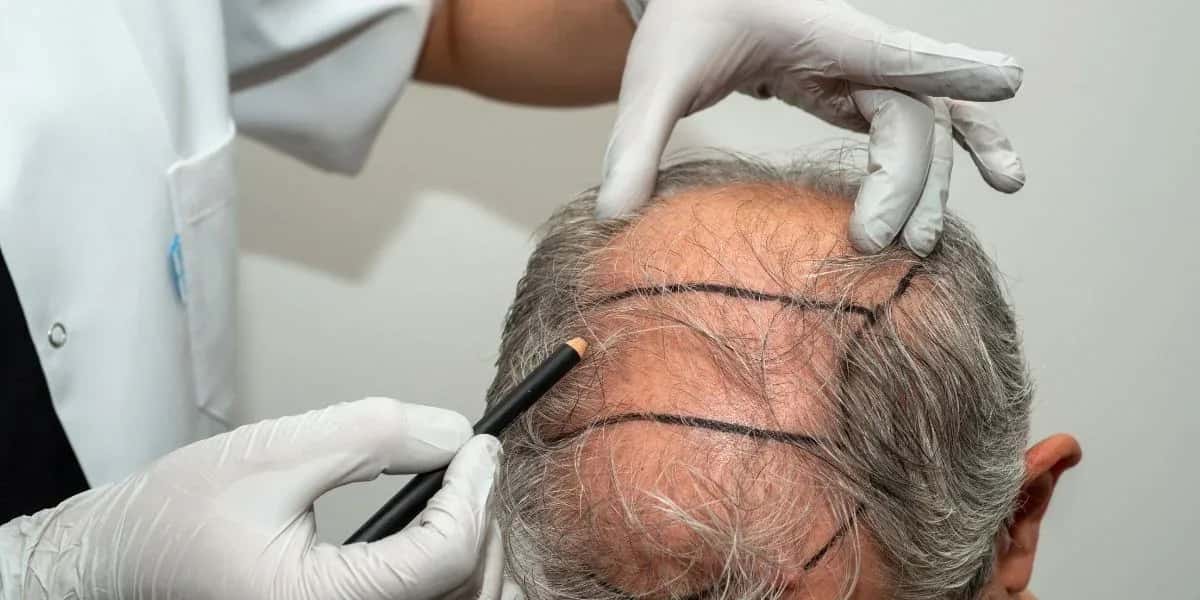 Hair Transplant Certificate
