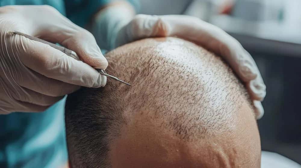 Hair Transplant During Ramadan