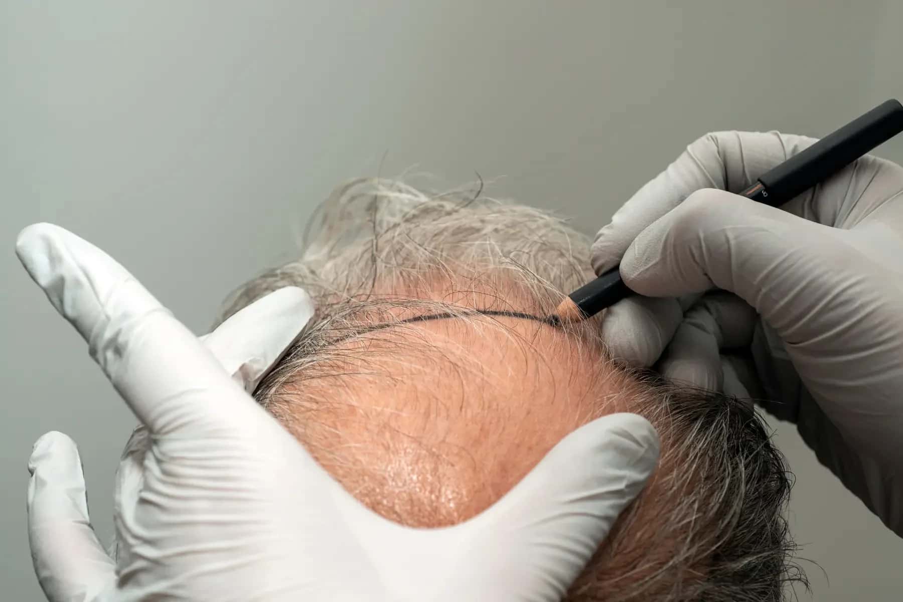 How to Choose a Hair Transplant Clinic in Ankara