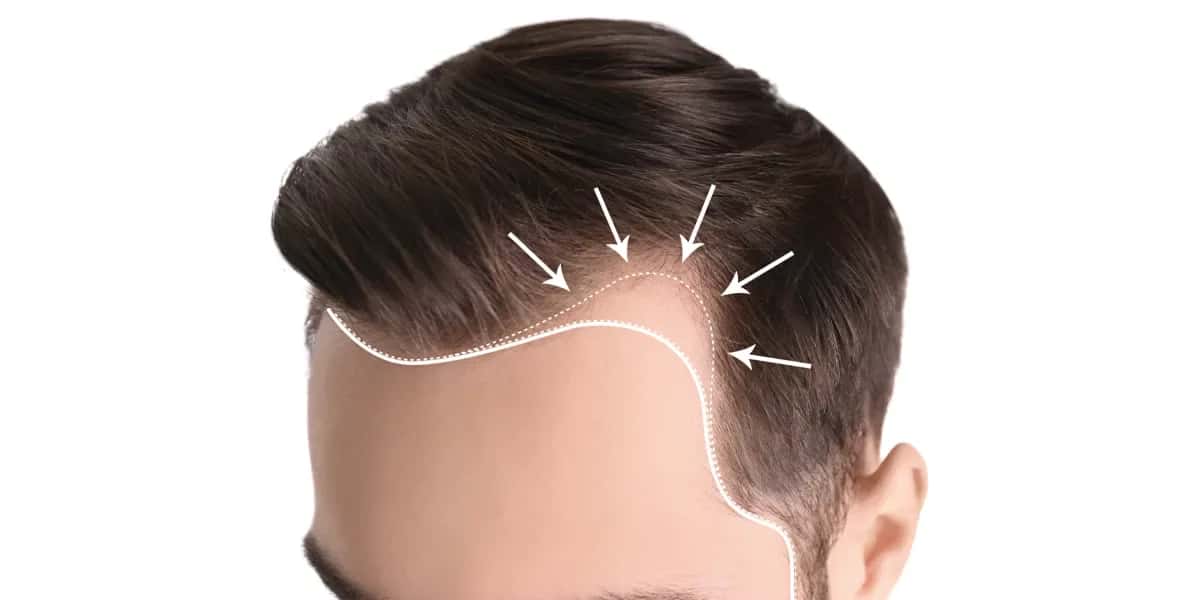 Implante ou Transplante Capilar: Qual é a Diferença e Como Funciona?