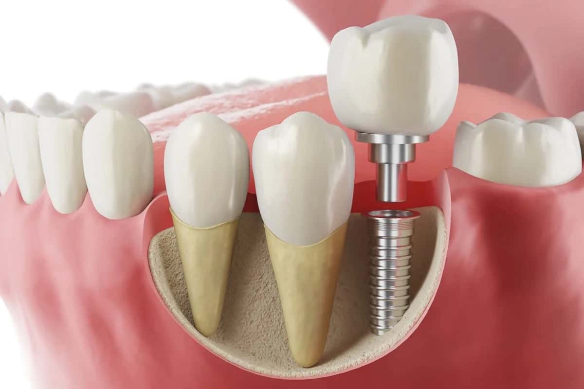 Is a Dental Implant Screw Visible?