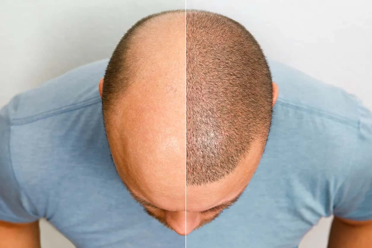 Is a Hair Transplant Something You Might Regret?