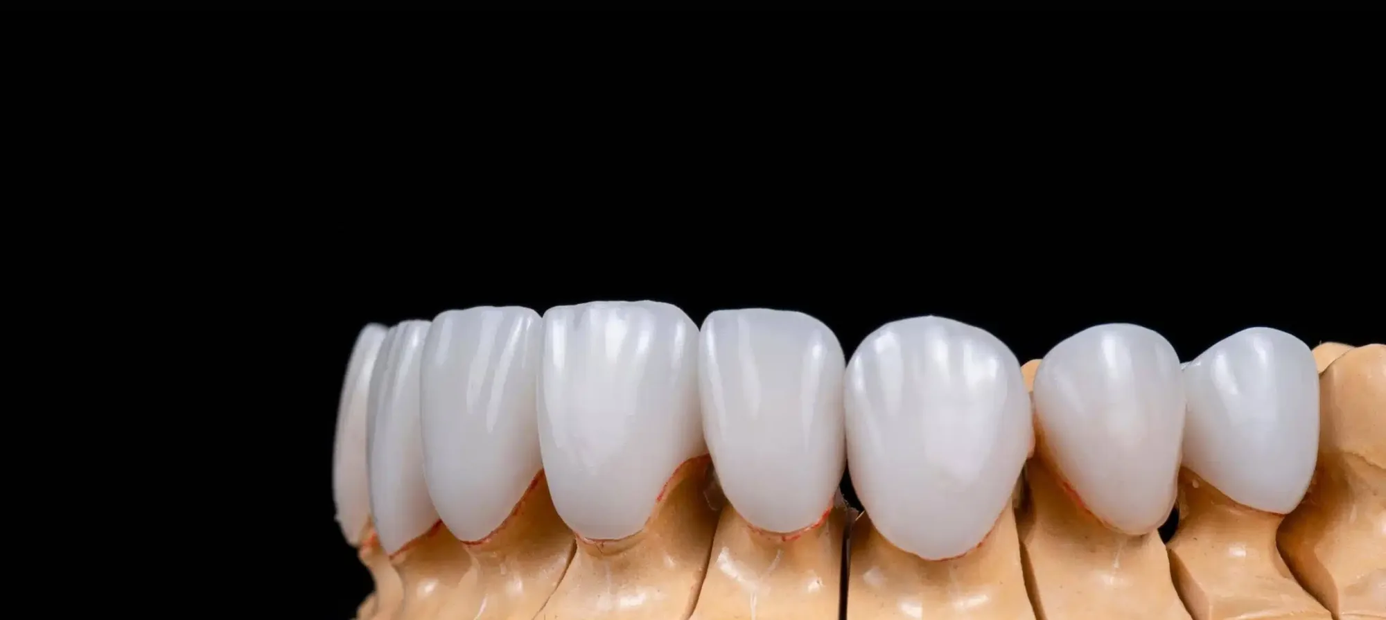 Laminate Veneers Costs Around the World