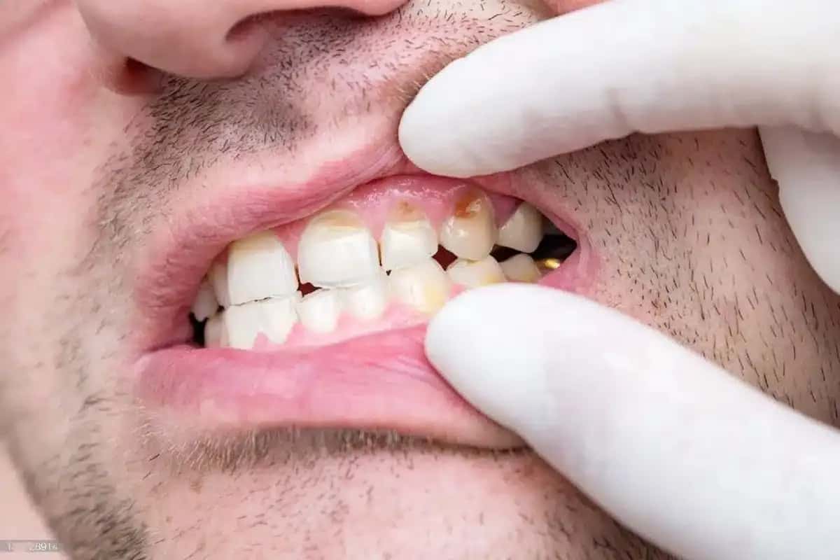 Les caries peuvent-elles provoquer des aphtes ? Est-ce dangereux ?