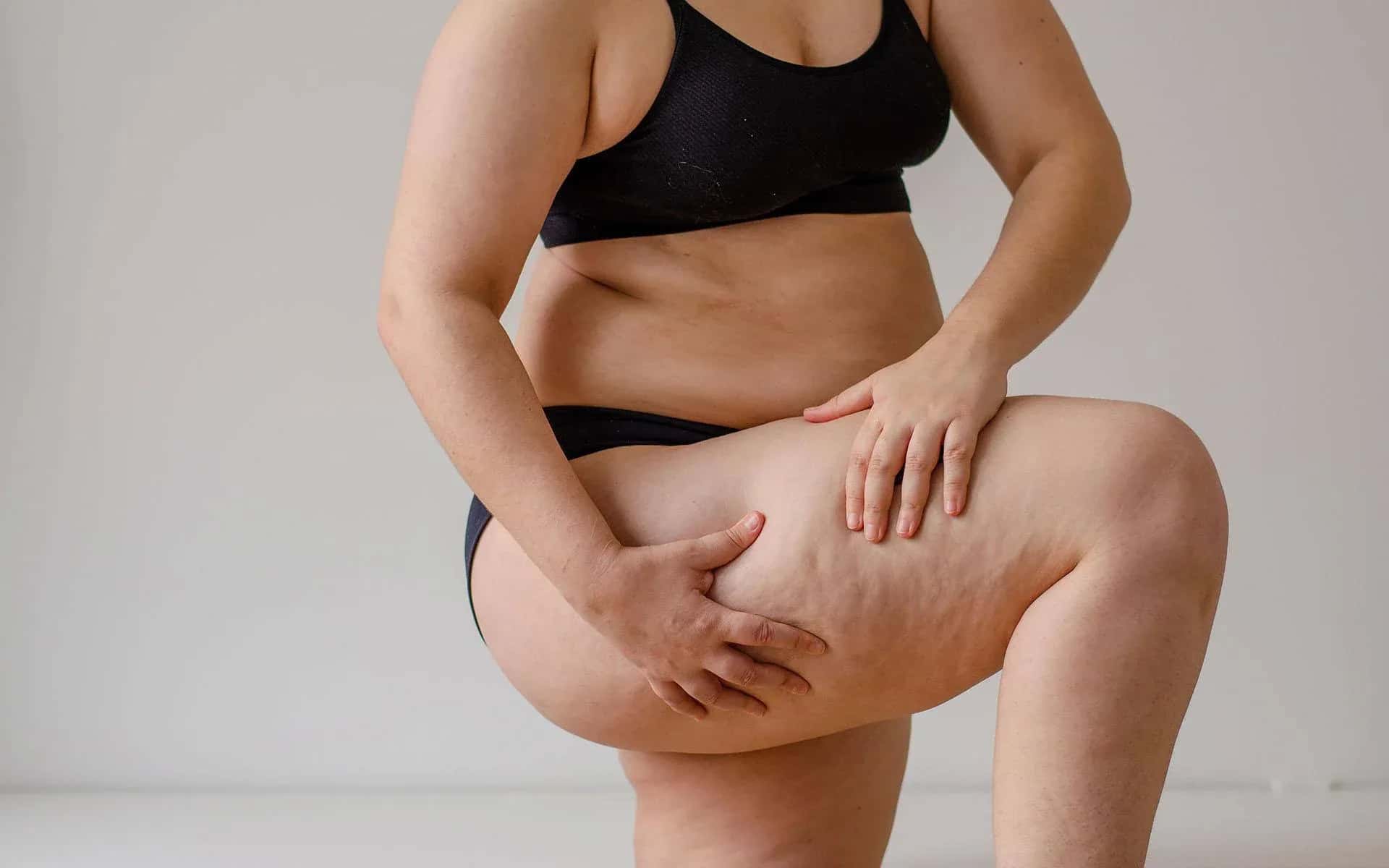 Lipedema: Symptoms, Diagnosis and Treatment