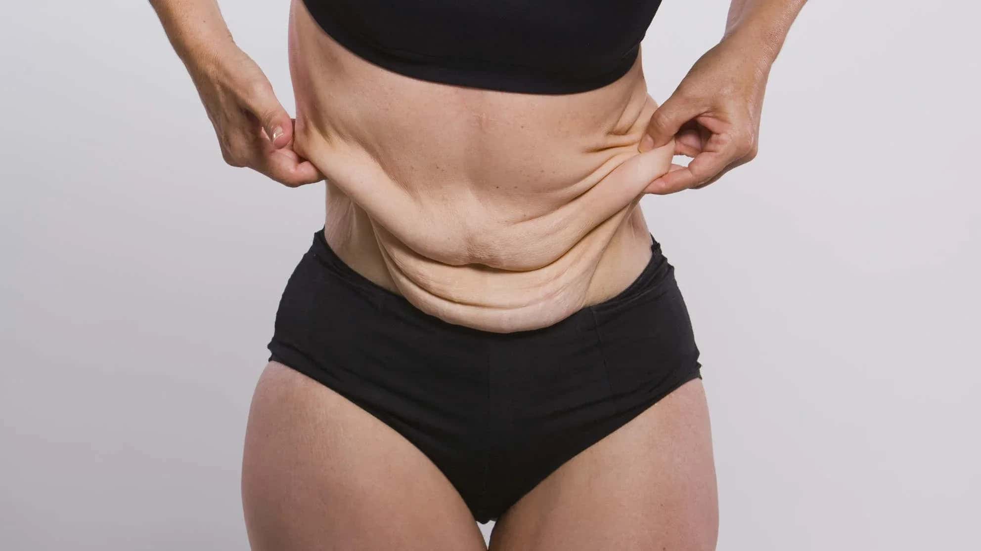 Loose Skin After Major Weight Loss