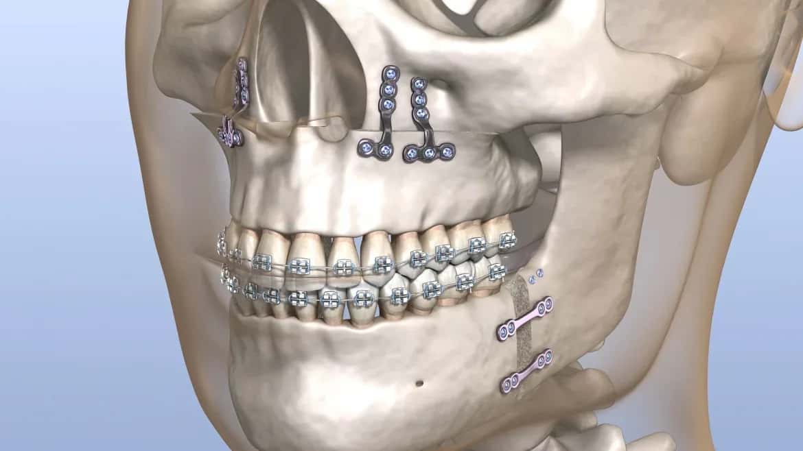 Orthognathic Surgery Costs Around the World: 2026 Country-by-Country Guide