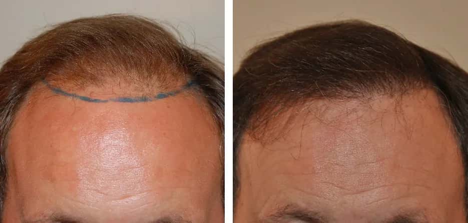 Price of a 1000 Graft Hair Transplant