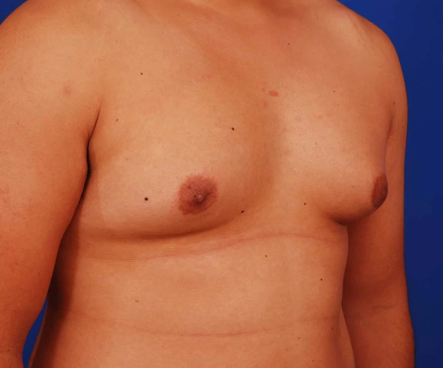 Pubertal Gynecomastia