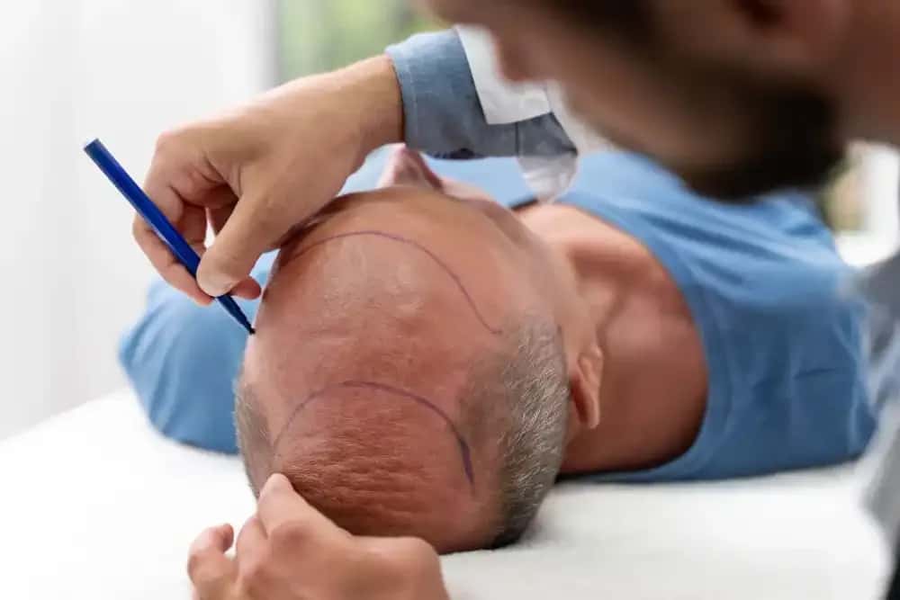 Quanto Custa um Transplante Capilar? Preços e Fatores