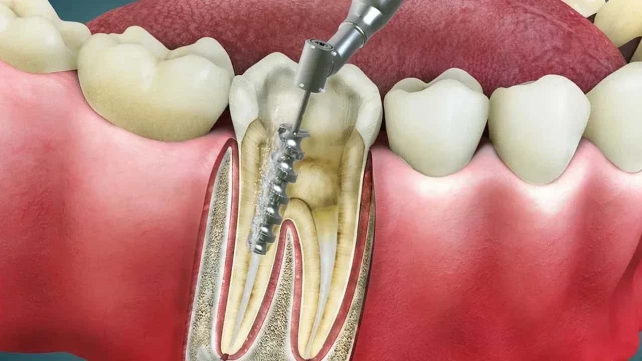 Root Canal Treatment Costs Around the World