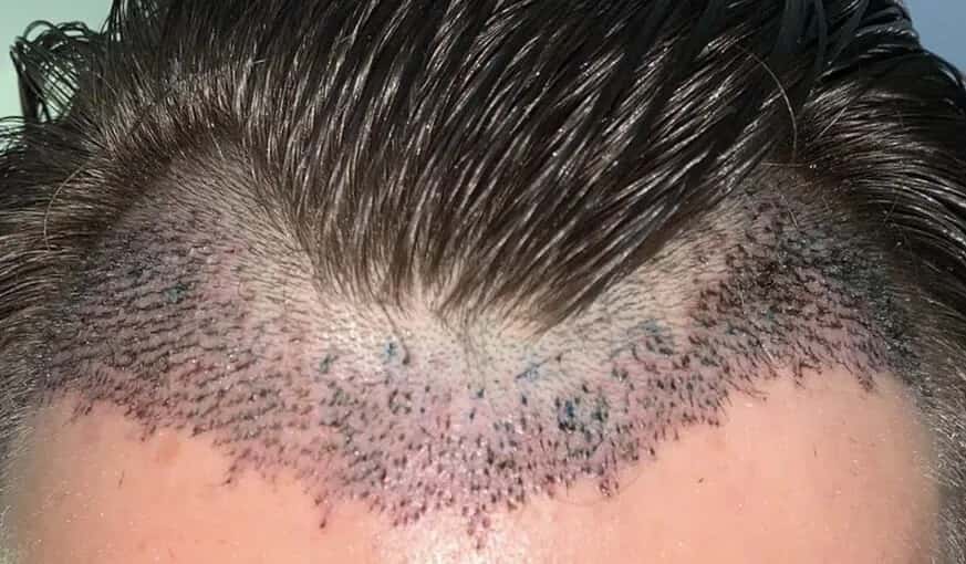 Shedding After Hair Transplant Surgery