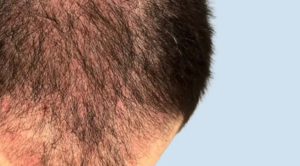 Shock Loss After a Hair Transplant