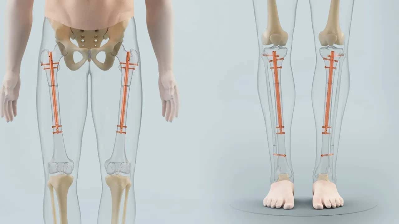 Surgery to Shrink Height