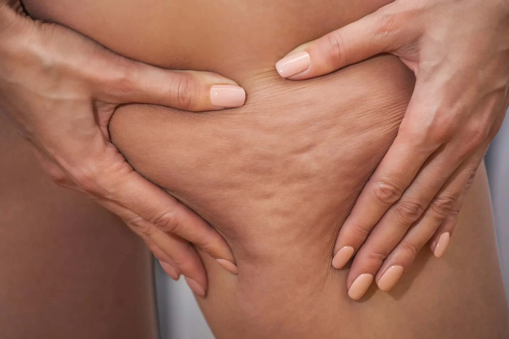 The Science Behind Cellulite Formation Explained