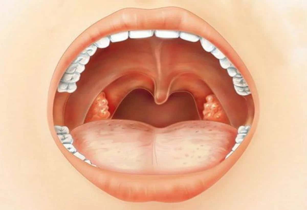 Tonsil Removal